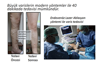 endovenoz