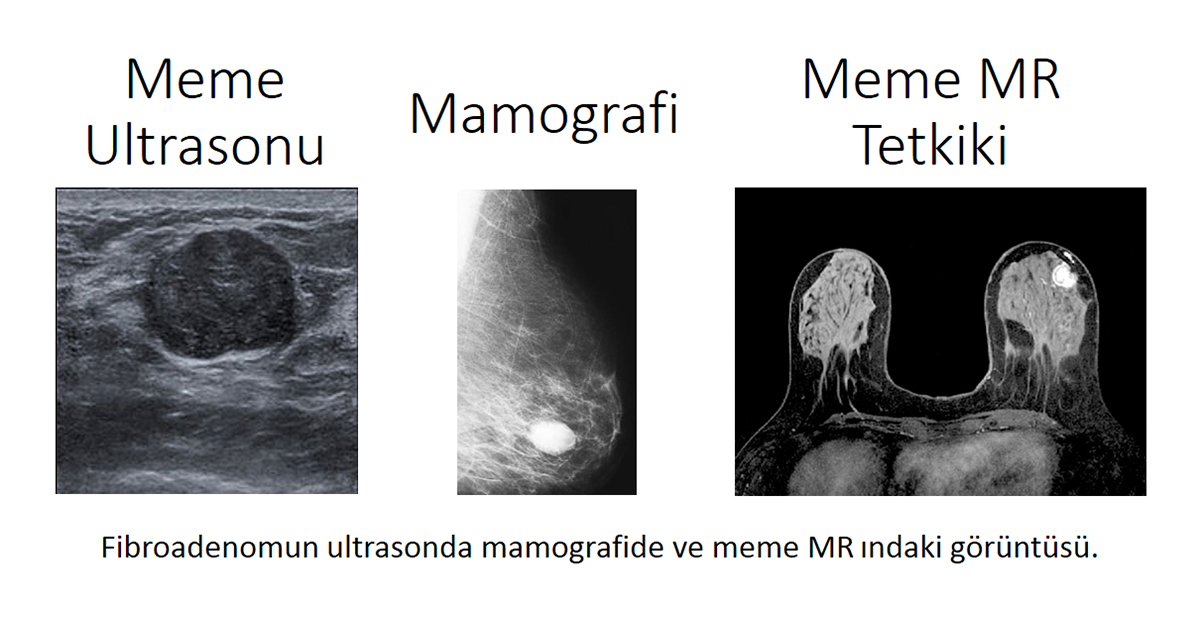 fibroadenom-ultrason