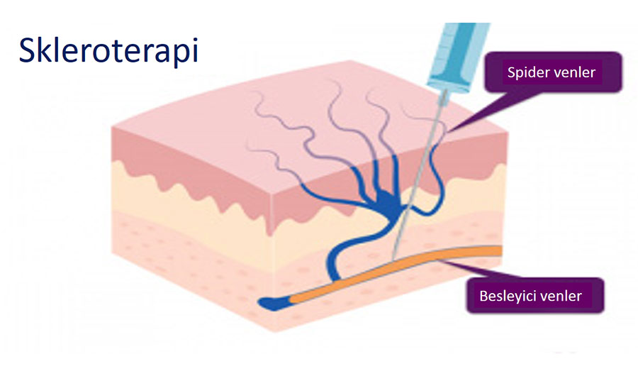 skleroterapi