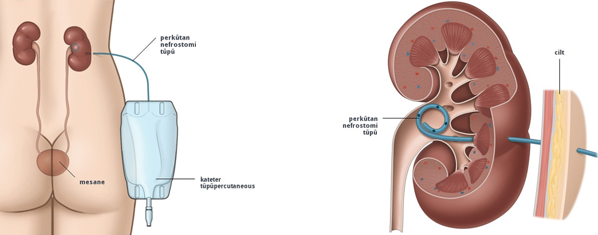 Perkütan Nefrostomi veya Stentleme
