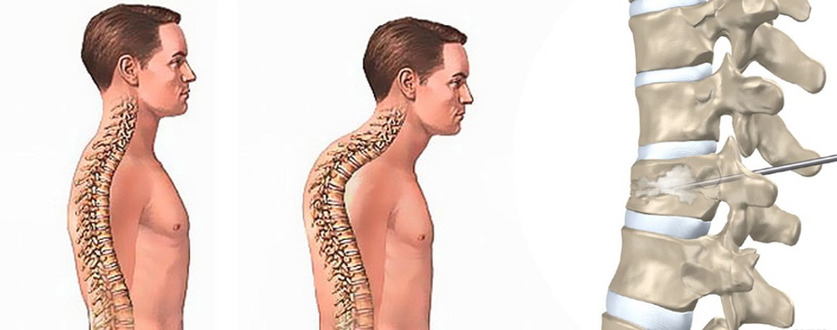 Sementoplasti ve Vertebroplasti