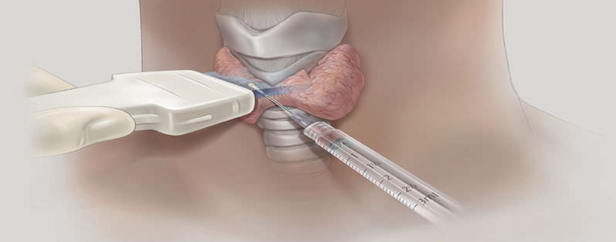 Tiroid Biyopsisi (İİAB) Nasıl Yapılır?